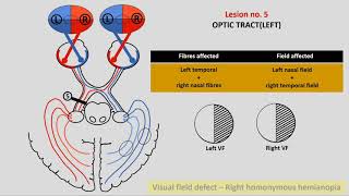 VISUAL PATHWAY Part 2  IN ENGLISH  Visual pathway lesions [upl. by Aracat958]