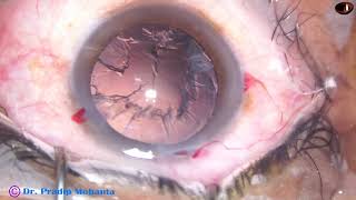 4 Golden Rings  unedited Phaco by Dr Dibyendu Saha  10th July 2024 [upl. by Yager]