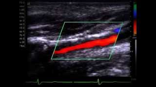 Doppler de carótidas e vertebrais [upl. by Roley]