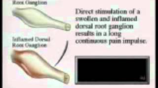 Adhesive Arachnoiditis Stages of Development and Common Cause [upl. by Roper857]