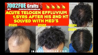 7002Grafts NW V 2HT 274 amp 269hgraft TDC20k Telogen effluvium 15 yrs after 2nd HT25932021 [upl. by Venezia]