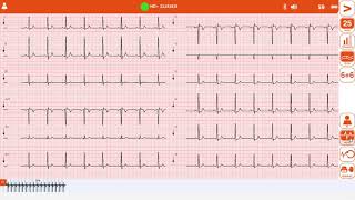 Acquisizione tracciato Ecg con elettrocardiografo Cardioline touch Ecg HD Plus [upl. by Onairelav742]