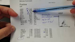 Hematology How to interpret automated Complete Blood Count CBC results [upl. by Nnylram932]