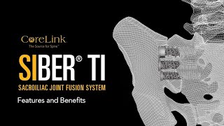 CoreLink Siber® Ti Sacroiliac Joint Fusion System—Features and Benefits [upl. by Enirac931]