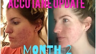 My Accutane Journey  2 Month Update [upl. by Urion]