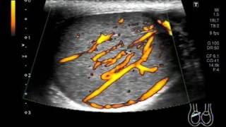 Ultrasound Video showing heterogeneous echogenicity of testis with pyocele [upl. by Hpsoj]