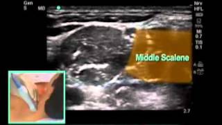 UltrasoundGuided Interscalene Brachial Plexus Nerve Block  SonoSitemp4 [upl. by Aeslahc]