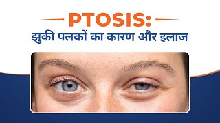 Ptosis  Droopy eyes पलकों का गिरना  झुकी पलकों का कारण और इलाज [upl. by Enivid221]