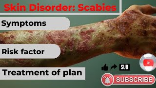 खुजली Scabies Treatment Management [upl. by Gaughan126]