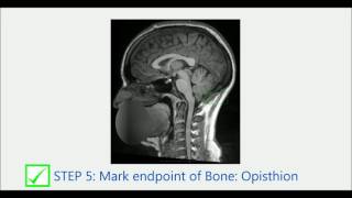 Demonstration of Fully Automated Tonsillar Position Measurement for Chiari I Malformation [upl. by Duke]