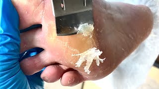 Callus removal from feetampFoot scraping dead skin【Xiao Yan pedicure】stress 51 [upl. by Yanrahc]