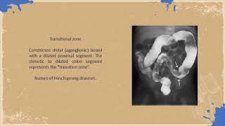 Meconium Ileus Review  Cases amp MCQs [upl. by Janiuszck]