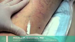 Sclerotherapy For Leg Veins  Mitchel P Goldman MD  San Diego [upl. by Dillon482]