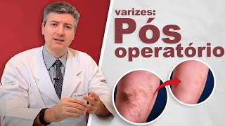 Como é o pós operatório da cirurgia de varizes laser e tradicional [upl. by Oilcareh971]