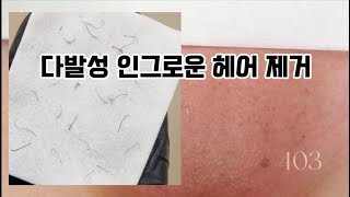 다발성 인그로운 헤어 제거 왁싱 후 생긴 부작용 [upl. by Ramah841]