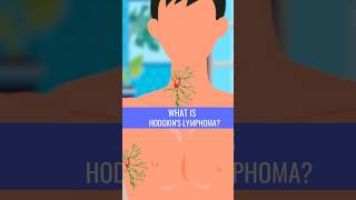 What is HODGKINS LYMPHOMA [upl. by Aleel]