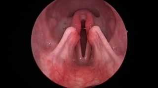 Dog Lar Par Laryngeal paralysis observed in sedated canine oral exam [upl. by Allimac]