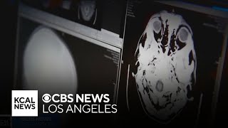 Santa Ana biotech company gets green light from FDA to continue promising new Alzheimers treatment [upl. by Denoting]