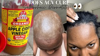 Treating My Seborrheic Dermatitis with ACV RINSE Remedy 🙆🏾😫👀😅 [upl. by Rickart]