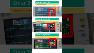 Normal Heart rate l Sinus Bradycardia l Sinus Tachycardia shorts [upl. by Lengel]