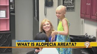 Wellness Wednesday What is alopecia areata [upl. by Cassady]