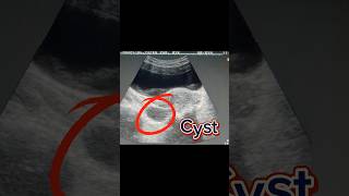 Bulky Uterus  Retroverted Uterus  Ovary Cyst  Simple Cyst on Ultrasound [upl. by Riess423]