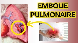 L Embolie Pulmonaire  Diagnostic  Traitement [upl. by Nivrag]