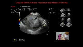 cistoadenocarcinoma mucinoso dellovaio destro [upl. by Bonne]