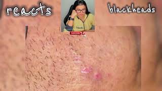 blackheads nose blackheads removal satisfying blackheads removal lips blackheads removal ear [upl. by Ialokin]