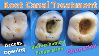 Root Canal Treatment in Maxillary First Permanent Molar 🟠 How to locate Mesiobuccal Canalsmb1mb2 [upl. by Dobb]