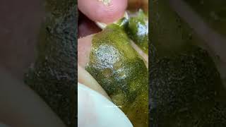 Blackheads Removal  Acne Treatment and Very Satisfying Satisfying Pimple pop blackheads [upl. by Aryek]