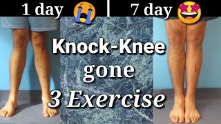 Knock knee problem solution with EXERCISES in 7 days [upl. by Hafital]