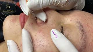 Loan Nguyen Acne Treatment 0794hn [upl. by Lanni]