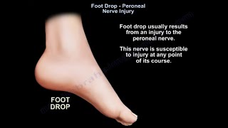 Foot Drop peroneal nerve Injury [upl. by Ihpen453]