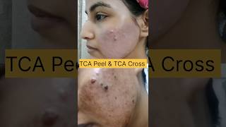 TCA Peel amp TCA Cross For Acne Scars acnescars skinpeel somethingnewwithrashi [upl. by Aon]