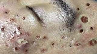 Toltal Best blackheads by Loan Nguyen No ads [upl. by Ellenod163]