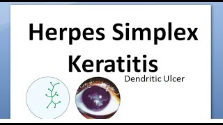 Ophthalmology 116 Herpes Simplex Keratitis Virus Cornea Dendritic HSV Wessley NeuroTrophic Disciform [upl. by Tioneb139]