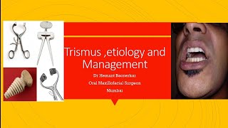 Trismus Management [upl. by Allisirp]