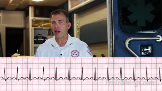 Supraventricular Tachycardia ECG Rhythm Interpretation [upl. by Aryek]