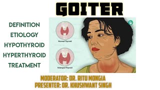 GOITER  SYMPTOMS  TREATMENT  LECTURE  THYROID [upl. by Ainex265]