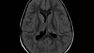 Tuberous Sclerosis [upl. by Lunt]