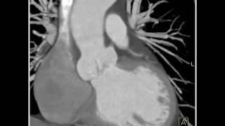 Cardiac Dilated aortic root and sinuses of Valsalva 7 of 10 [upl. by Nnayram]