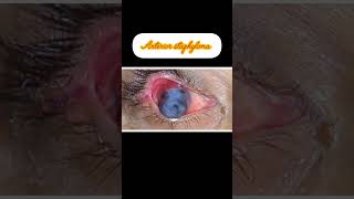 staphyloma structure type youtube viral videos [upl. by Akiner838]