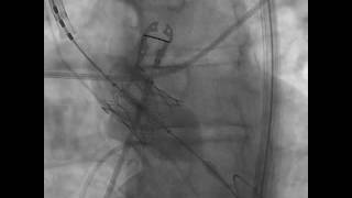 TAVR Implantation Aortogram under Fluoroscopic Guidance SAPIEN 3 [upl. by Inger562]