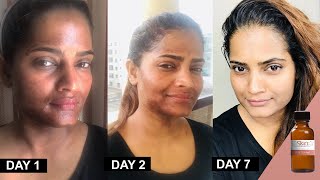 25 TCA Chemical Peel at home method and progress by Hina UrduHindi [upl. by Joanie]