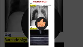 Pneumothorax Diagnosis Xray amp Usg Pearls NEET PG INICET [upl. by Ennadroj]