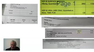 Hepatitis b viral loads [upl. by Segal208]