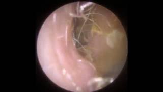 Endoscopic Removal of Soft Ear Wax  Mr Neel Raithatha The Hear Clinic  Leicester [upl. by Augustine]