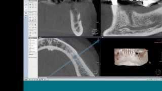 WebinarTeaser Die richtige Planung und Kontrolle von Implantaten [upl. by Semreh]