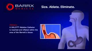 BARRX Medical HALO360 ablation technology [upl. by Seidel]